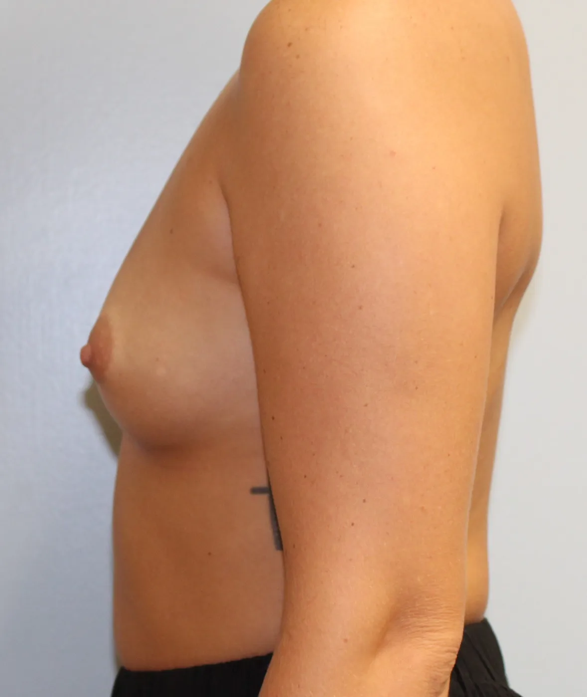 Breast Augmentation case 3, before, left side view