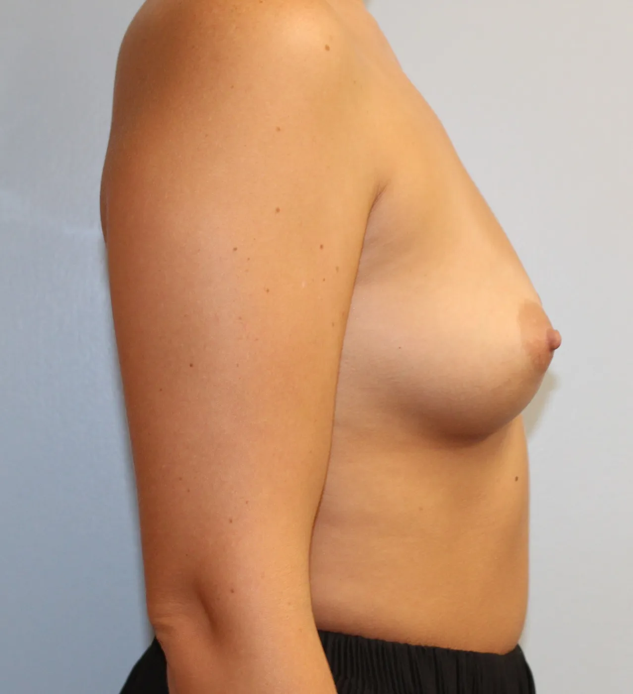 Breast Augmentation case 3, before, right side view