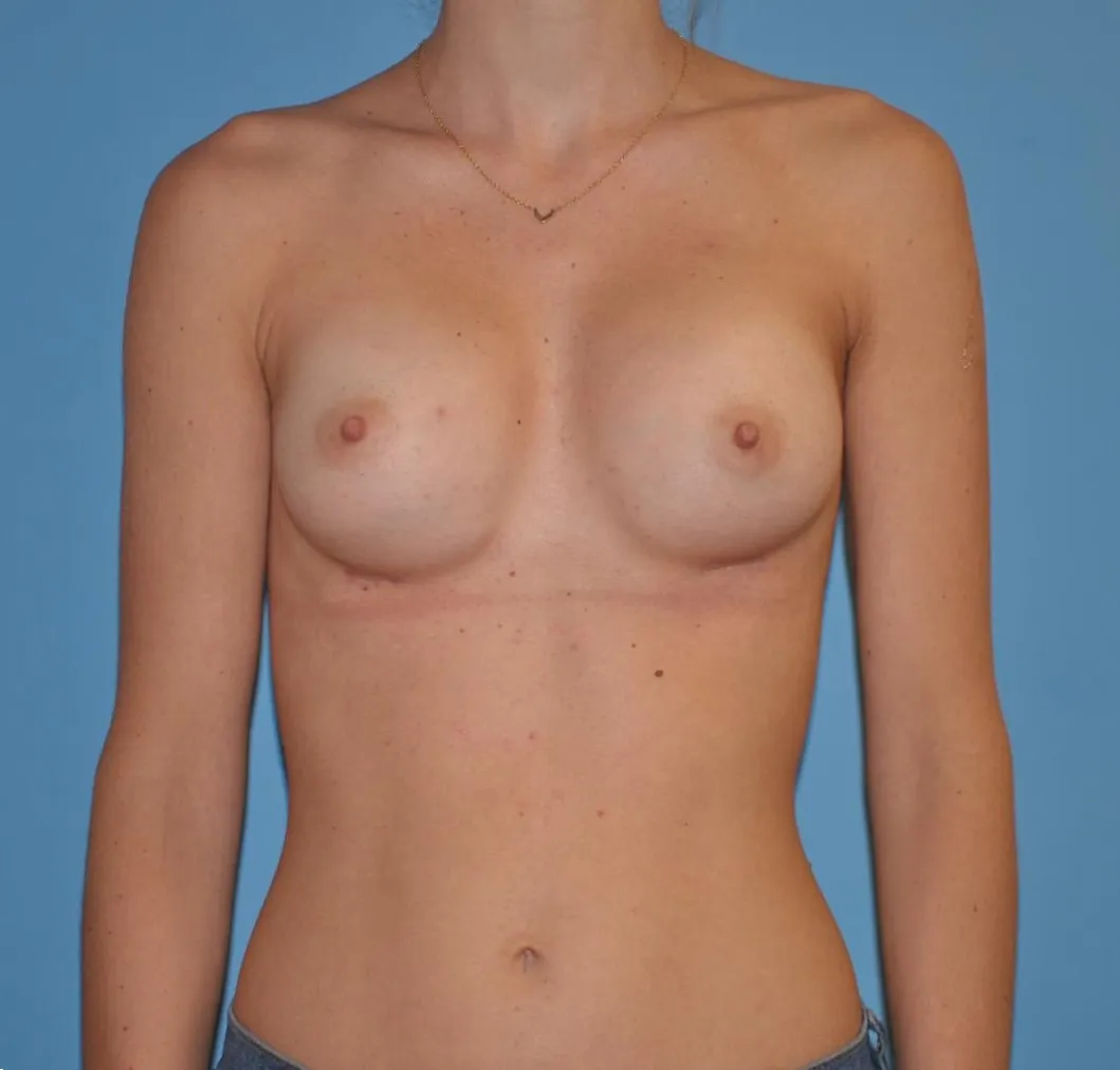 Breast Augmentation case 6, after, front view