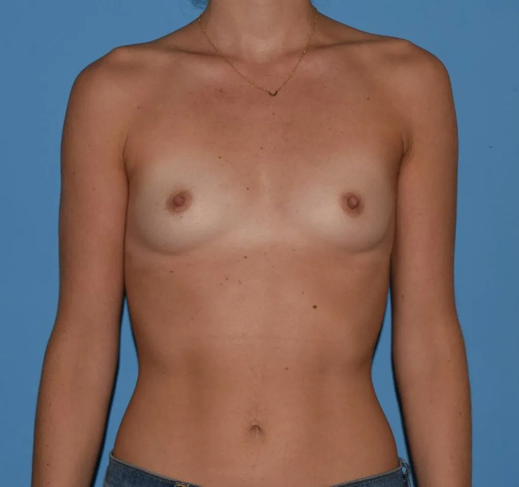 Breast Augmentation case 6, before, front view