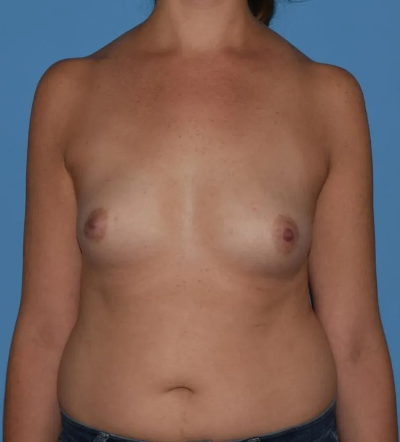 Breast Augmentation case 8, before, front view