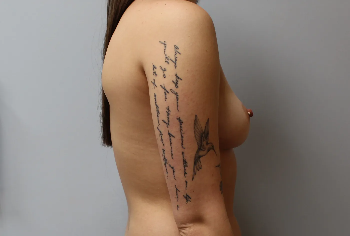 Breast Augmentation case 11, before, right side view