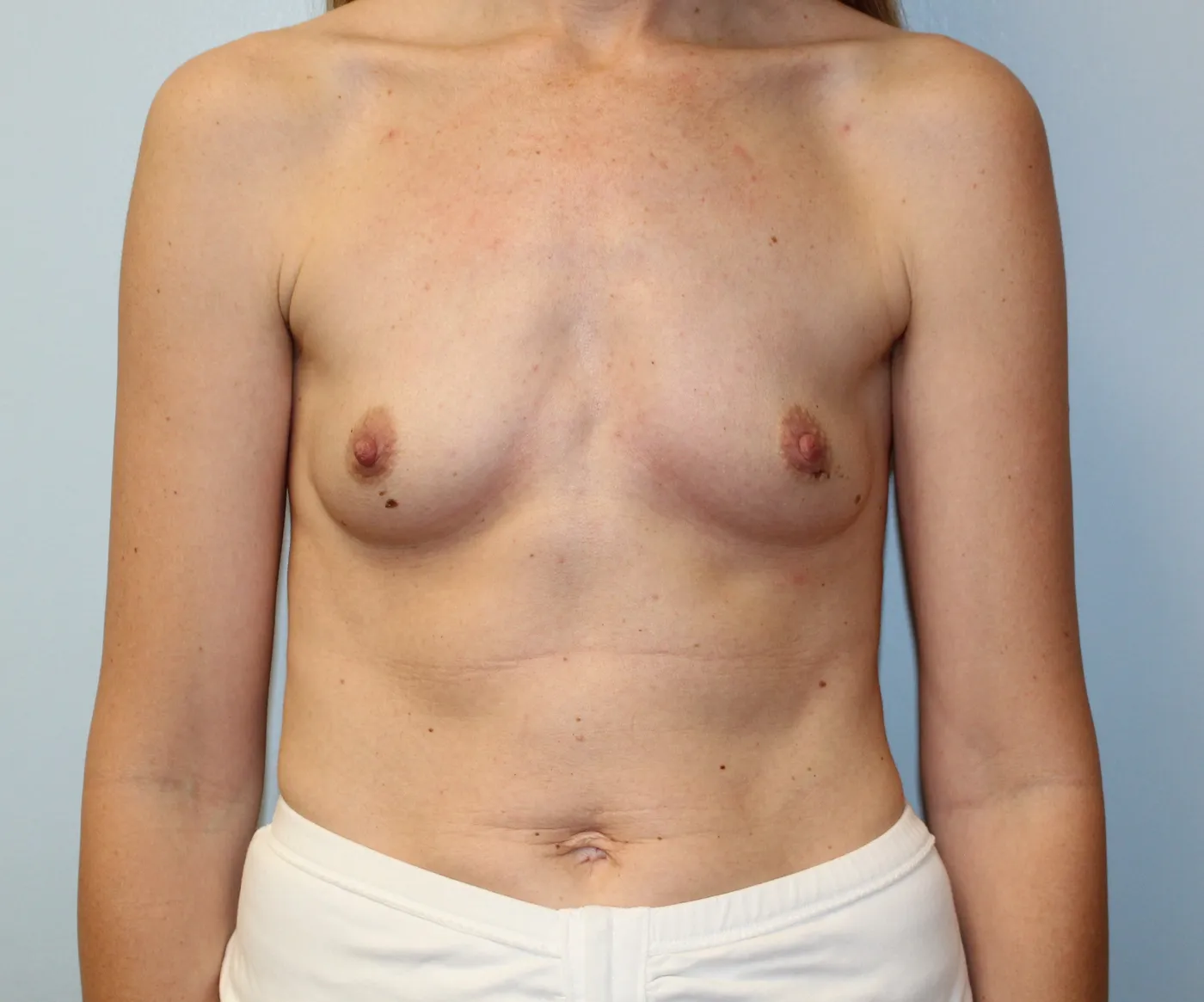 Breast Augmentation case 12, before, front view