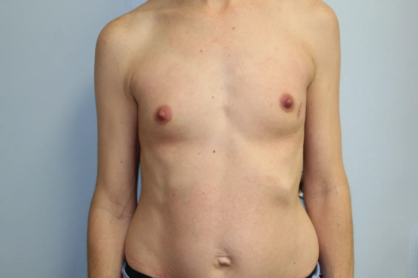 Breast Augmentation case 13, before, front view