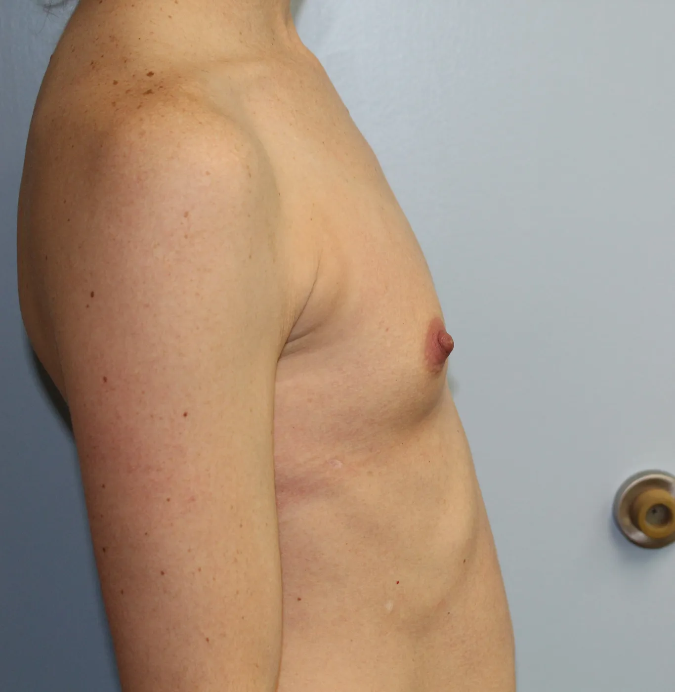 Breast Augmentation case 13, before, right side view