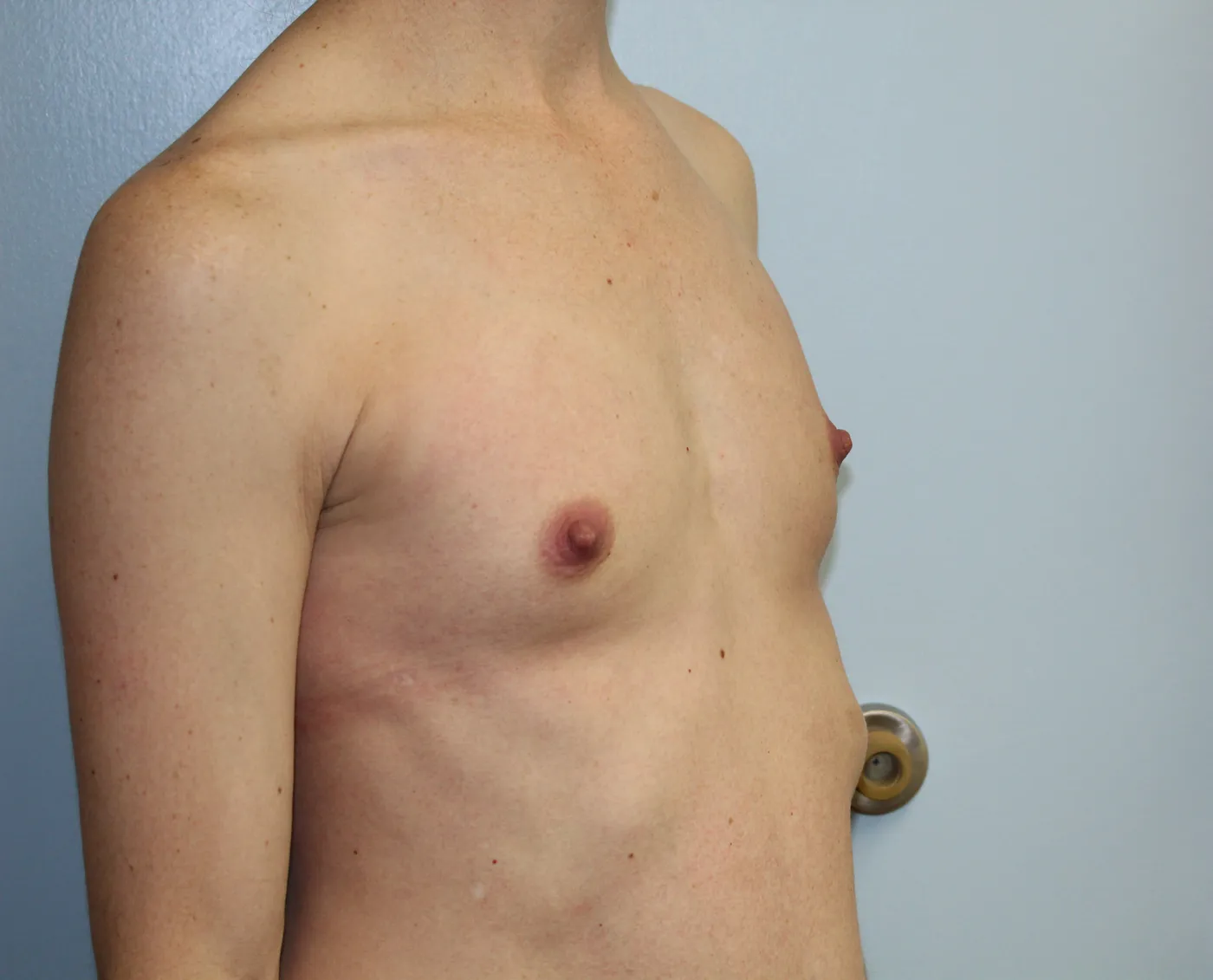 Breast Augmentation case 13, before, right oblique view
