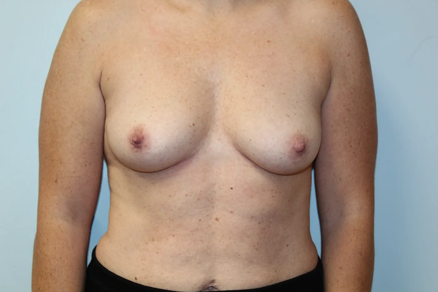 Breast Augmentation case 14, before, front view