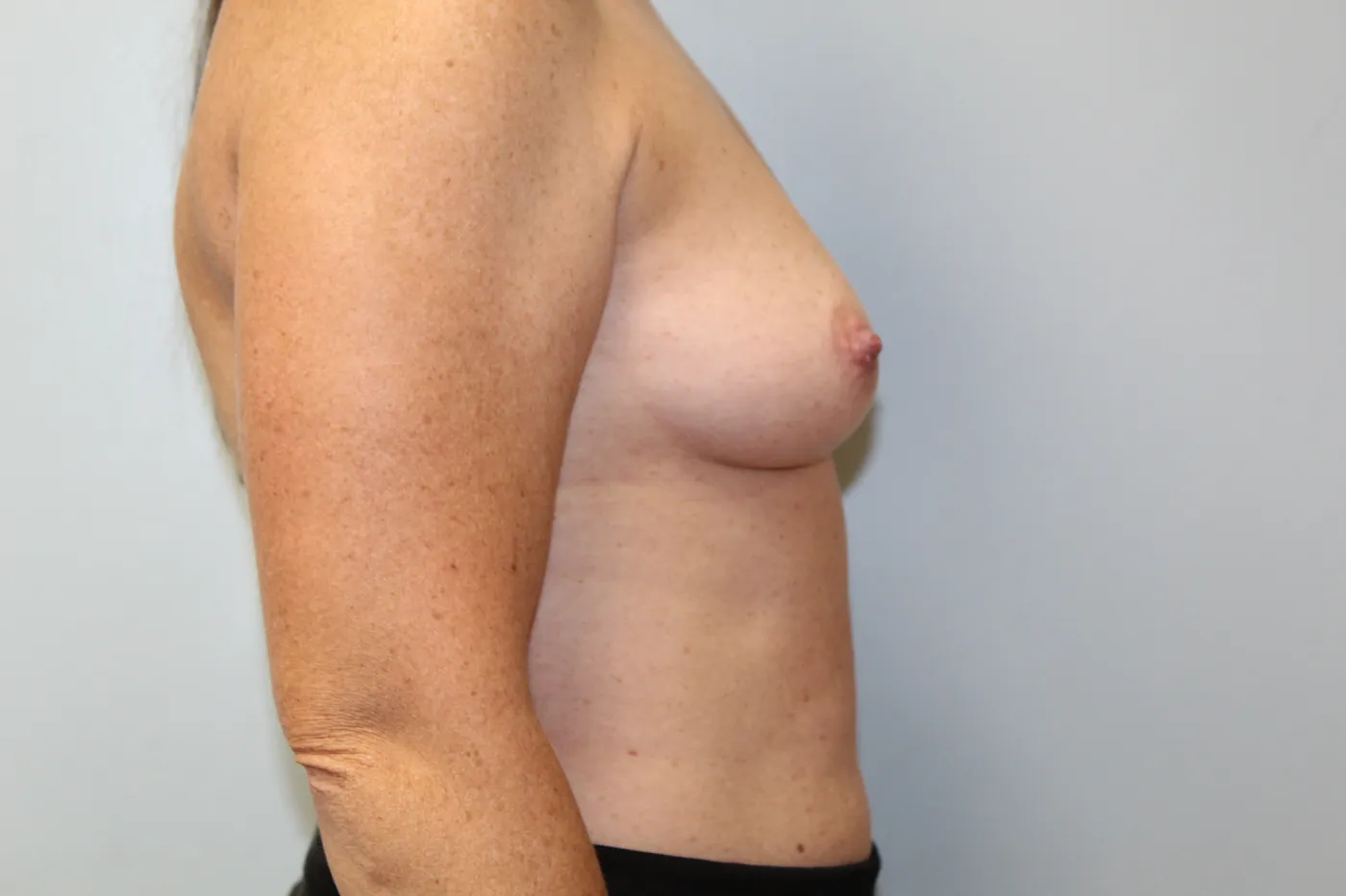 Breast Augmentation case 14, before, right side view