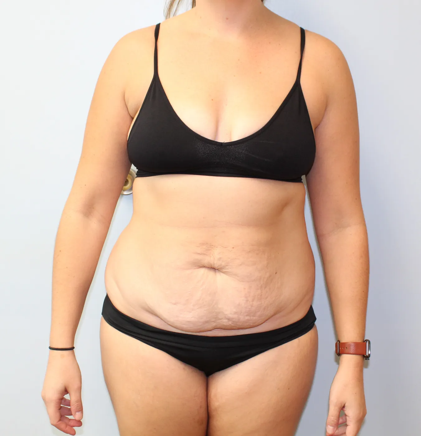 Tummy Tuck case 1, before, front view