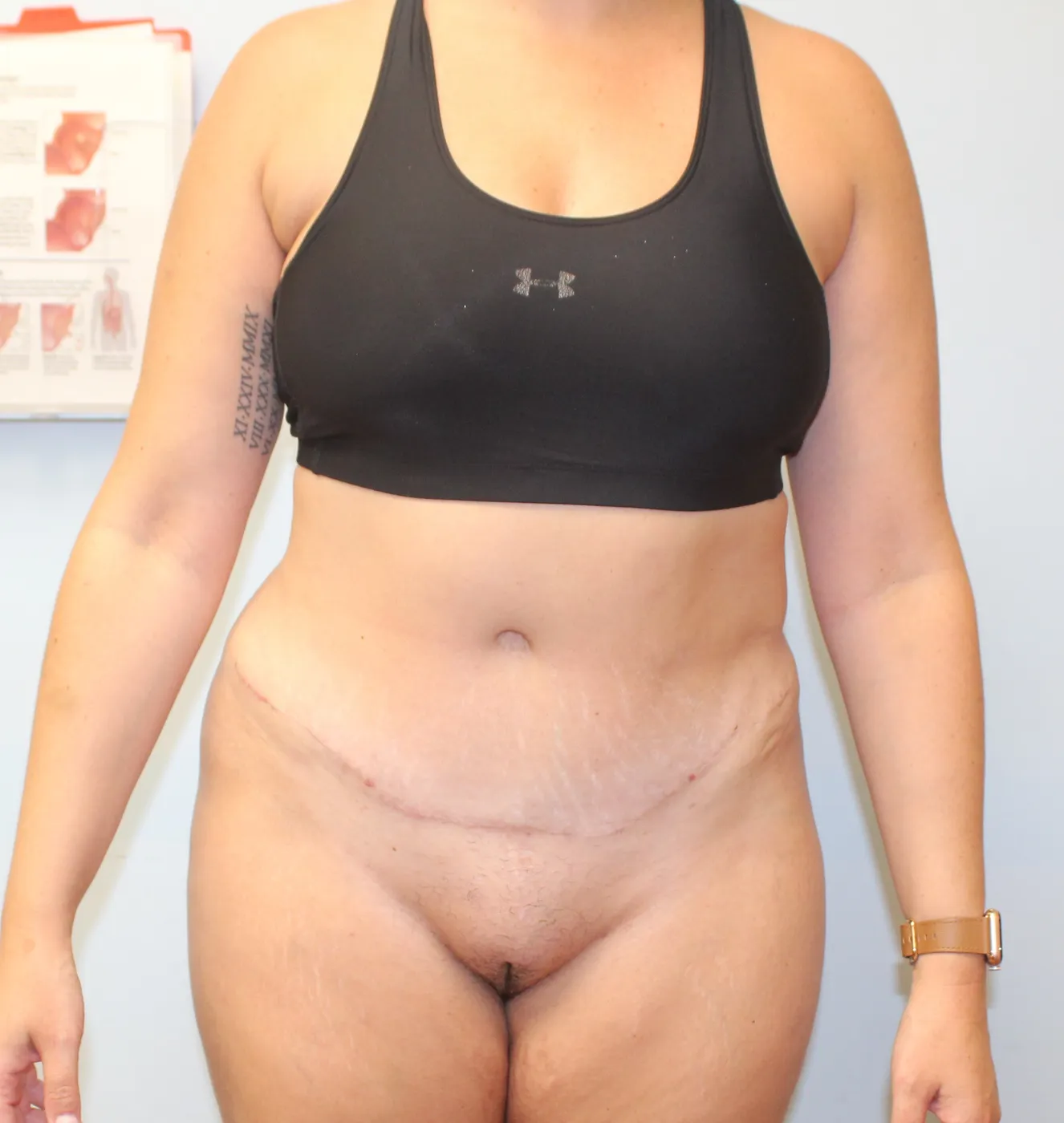 Tummy Tuck case 1, after, front, incision view