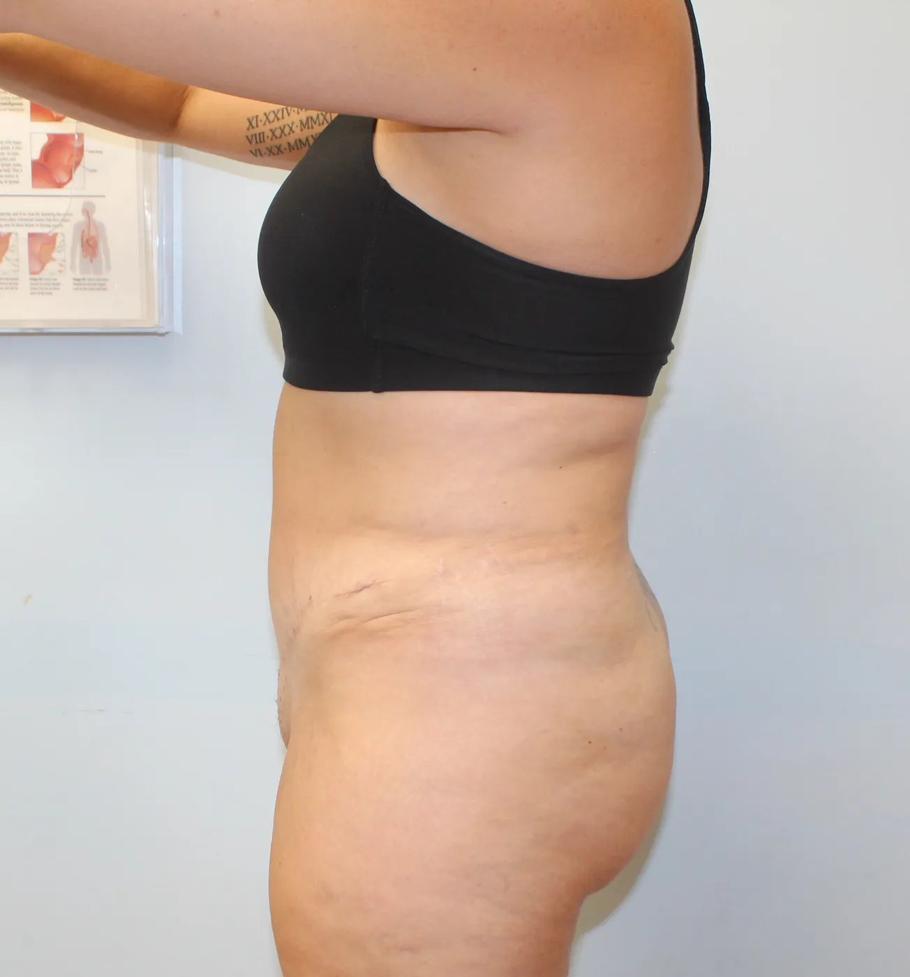 Tummy Tuck case 1, after, left side, arms up view