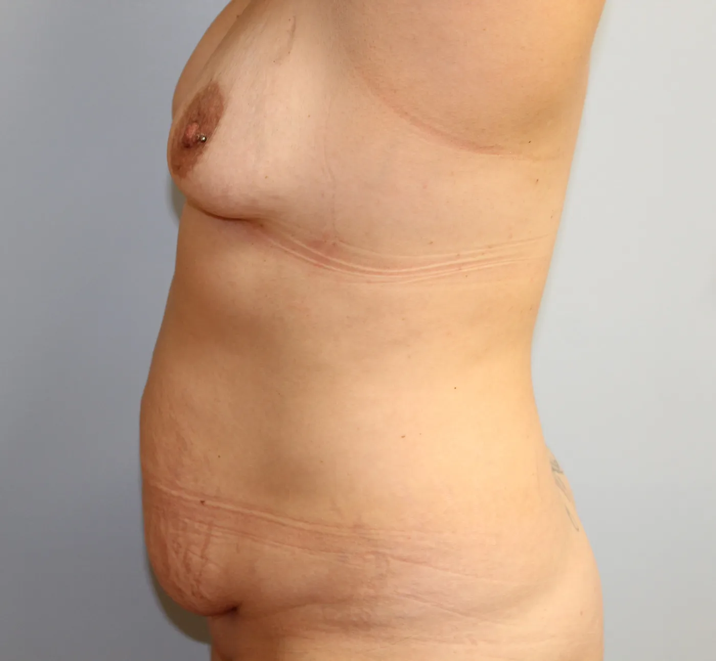 Tummy Tuck case 1, before, left side, arms up view