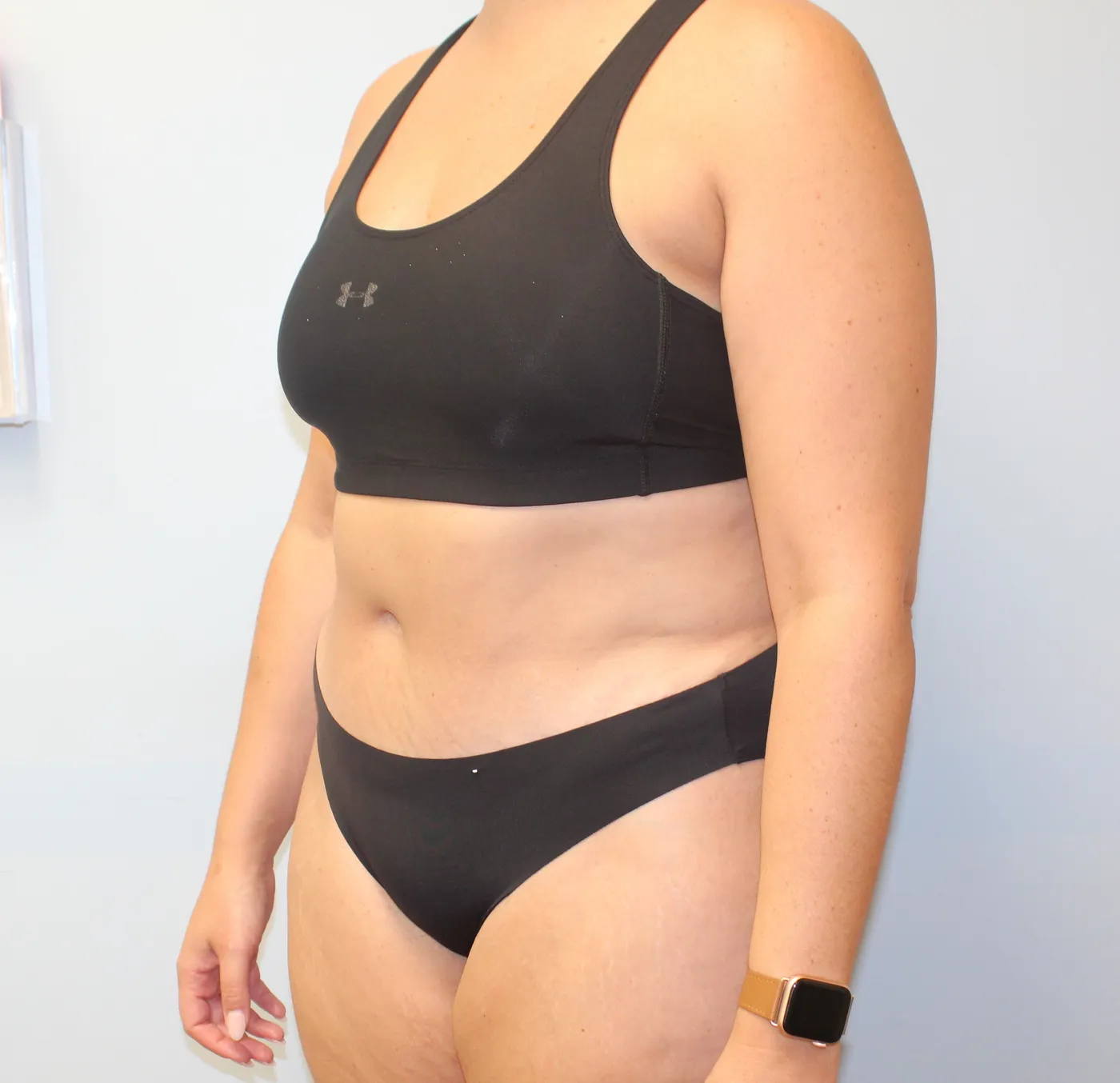 Tummy Tuck case 1, after, left oblique view