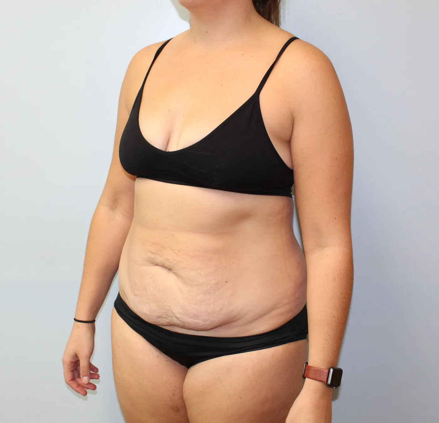 Tummy Tuck case 1, before, left oblique view