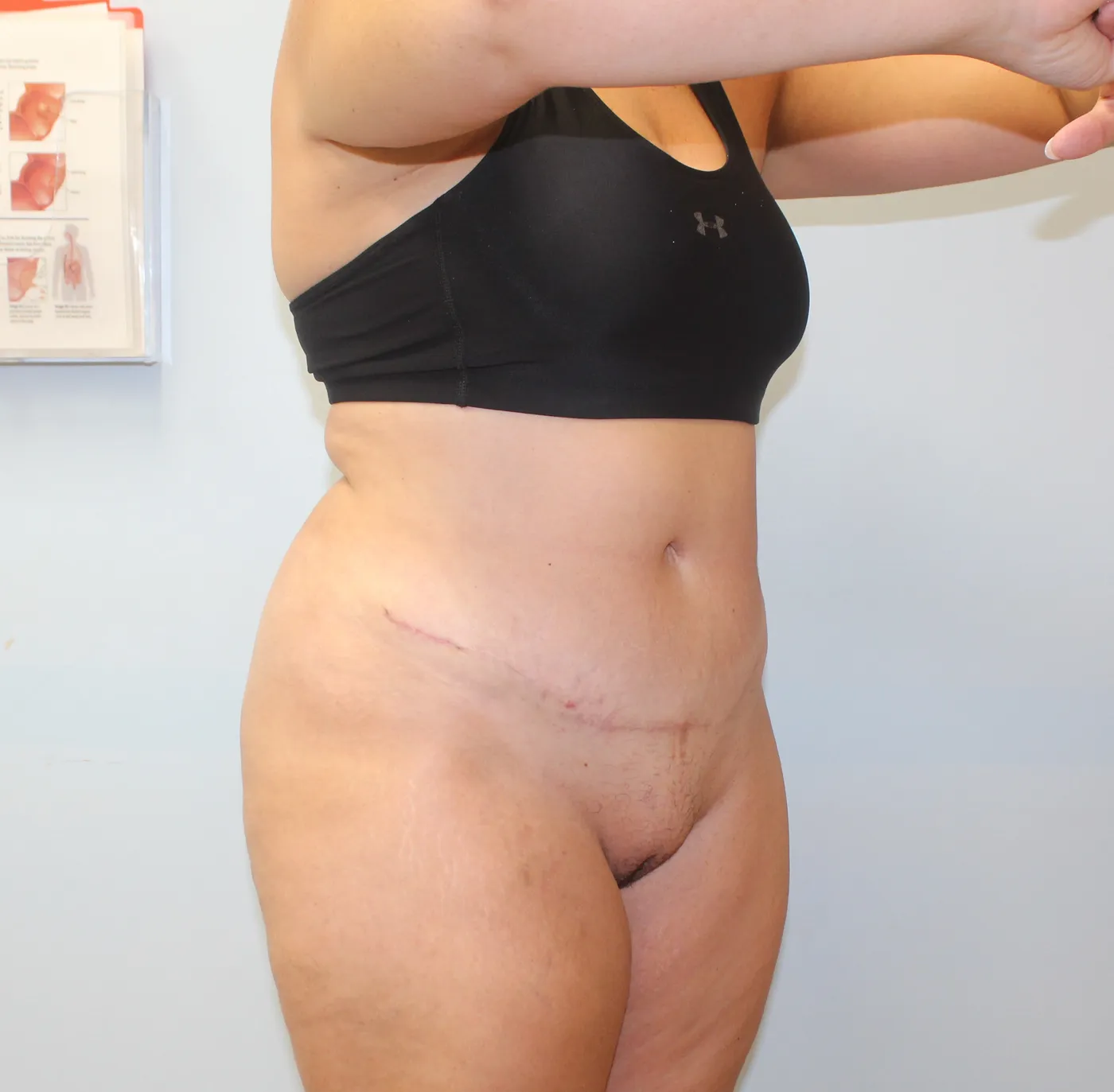 Tummy Tuck case 1, after, right side, arms up view